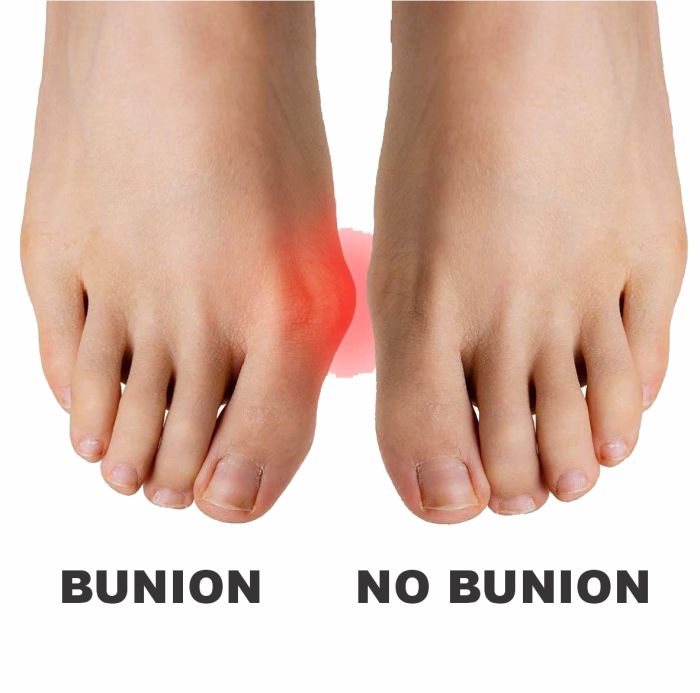 My Feet Gel Bunion Guard with Toe Spacer One Size (PAIR)